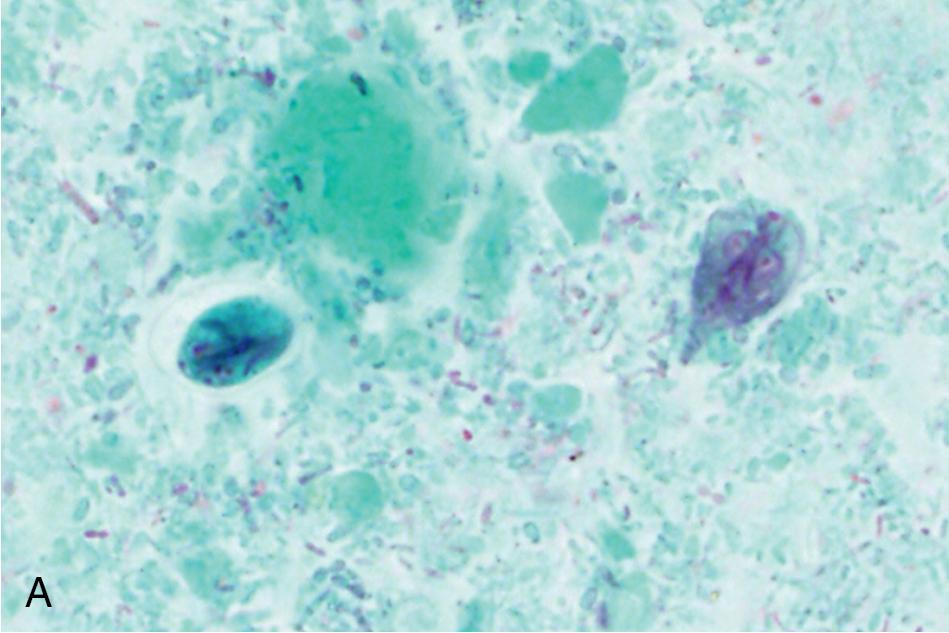 FIGURE 88.37, Intestinal and urogenital flagellates, Blastocystis species , and Balantioides coli. (A) Giardia duodenalis cyst (left) and trophozoite (right). (B) Chilomastix mesnili cyst ( arrow denotes hyaline knob at anterior end). (C) Chilomastix mesnili trophozoite. (D) Trichomonas vaginalis trophozoites. (E) Blastocystis sp. cysts. (F) Balantioides coli cyst (left) and trophozoite (right) with a clearly visible “kidney bean”–shaped macronucleus. Organisms in A–C and E are stained with Wheatley’s trichrome, while organisms in D and F are stained with Giemsa; all are shown at 1000× magnification.