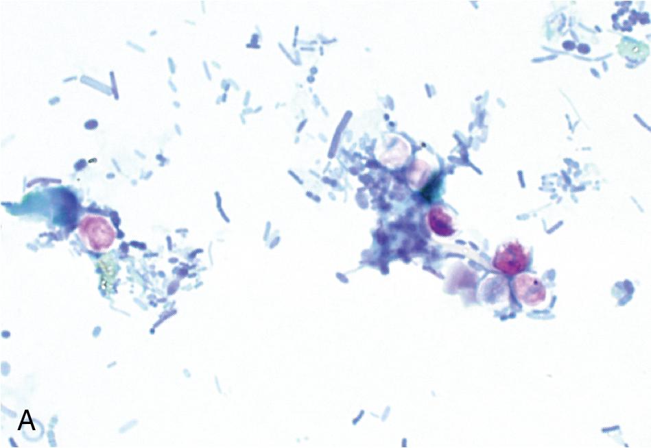 FIGURE 88.38, Cryptosporidium and the coccidia in permanent-stained stool and wet mount preparations. (A) Cryptosporidium spp. oocysts. (B) Cyclospora cayetanensis oocysts. (C) Cystoisospora belli oocysts, each with a single sporoblast. (D) Cyclospora cayetanensis , oocysts in a wet mount demonstrating autofluorescence when examined with the proper UV wavelengths, 400× magnification. Images A–C are stained with a modified acid-fast stain, at 1000× magnification.