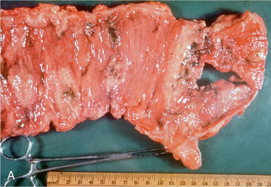 FIGURE 88.40, Entamoeba histolytica infection demonstrating severe amebic colitis (A) and amebic liver abscess (B). The material aspirated from the amebic liver abscess (B, test tube) is said to resemble “anchovy paste.”