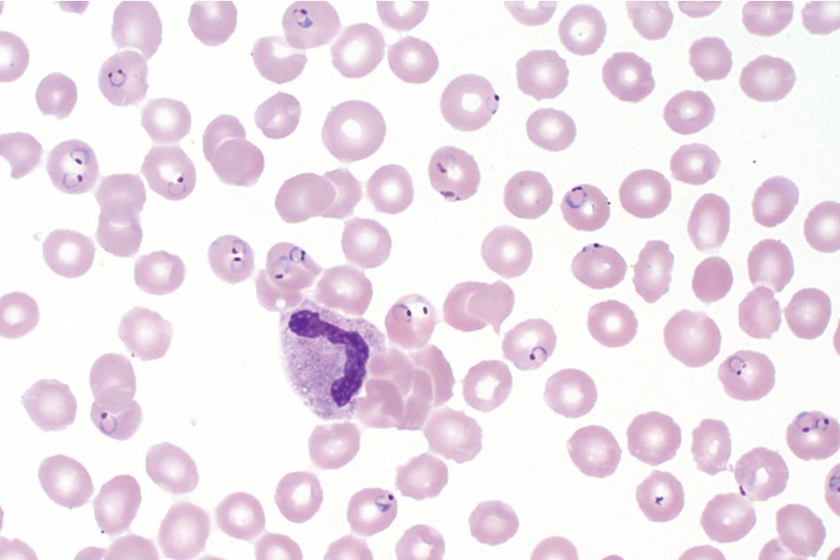 FIGURE 88.4, Thin blood film showing numerous erythrocytes infected by early trophozoite (ring) forms of Plasmodium falciparum . Note that some erythrocytes are infected by more than one parasite, as is common with P. falciparum infection (Giemsa, 1000×).