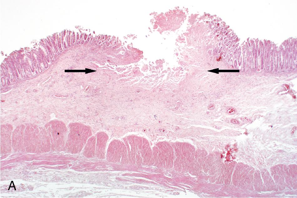 FIGURE 88.41, Histopathology of Entamoeba histolytica. At low magnification (A), note that the ulcer is wider at the base (arrows) than the apex, giving it a “flask” shape (H&E, 40×). Amebic trophozoites are most easily identified at the advancing edge of the ulcer in the submucosa (B, arrows ) (H&E, 200×). Occasional trophozoites with ingested erythrocytes are present (B, inset, 1000×).