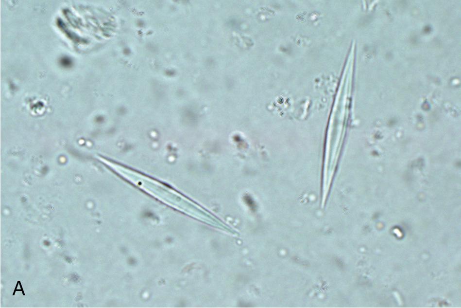 FIGURE 88.5, Wet mount fecal preparations demonstrating slender pointed Charcot-Leyden crystals (A), leukocytes (B, arrowheads ), and erythrocytes (B, arrows ) (unstained, 1000×).