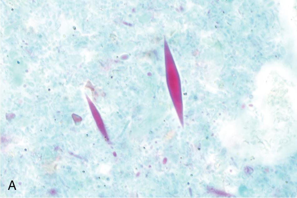 FIGURE 88.6, Permanently stained fecal preparations demonstrating deep pink Charcot-Leyden crystals (A), leukocytes (B, arrowheads ), and erythrocytes (B, arrows ) (Wheatley’s trichrome, 1000×).