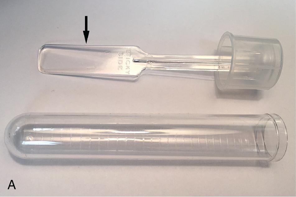 FIGURE 88.8, An example of a commercial collection device (Swube, Becton Dickinson, Franklin Lakes, NJ) for sampling perianal skin for Enterobius vermicularis eggs and adults in place of the conventional cellulose tape test (A). With commercial devices, the paddle (arrow) has a sticky side that can be applied to the skin to collect the specimen. The entire paddle then fits into the accompanying tube for safe transport to the laboratory. The clear paddle functions like a glass slide and can be viewed directly under the microscope. Positive specimens demonstrate E. vermicularis eggs (B) and, less commonly, adult females. Eggs measure 50 to 60 μm in length by 20 to 30 μm in width and are flattened on one side (unstained, 400×).