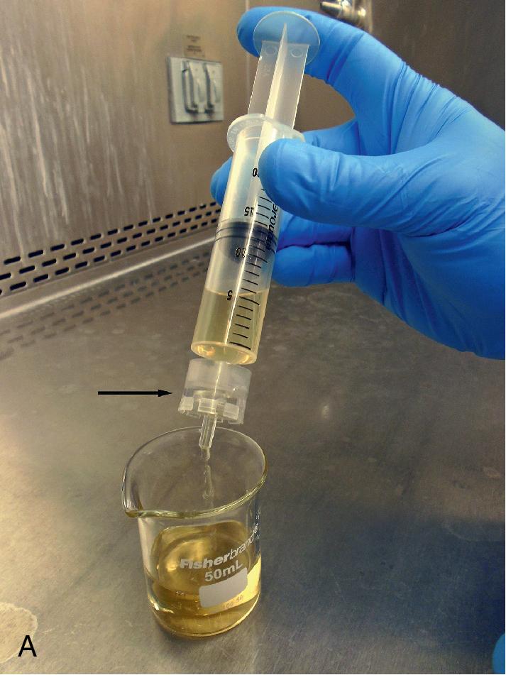 FIGURE 88.9, Urine being filtered through a Whatman Nucleopore Track-Etched Membrane (GE Healthcare Life Sciences, Pittsburgh, Pennsylvania) for detection of Schistosoma haematobium eggs (A). The filter apparatus (arrow) is then removed, and the filter is examined microscopically for the presence of eggs (B); shown here are two S. haematobium eggs (center of image; unstained slide, 200×). The small circles seen throughout the image are the holes in the membrane.