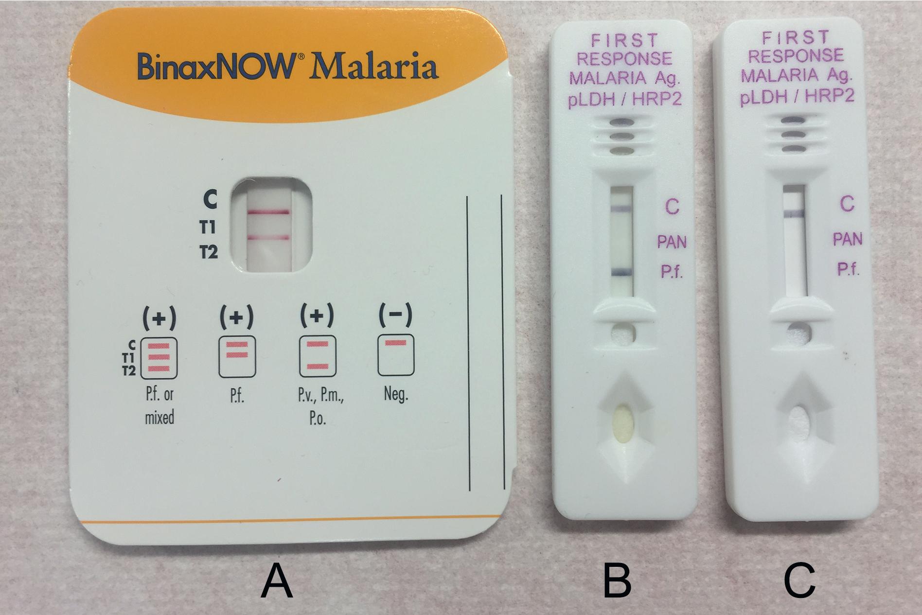 FIGURE 88.10, Two commercially available lateral flow immunochromatographic assays for rapid detection of Plasmodium spp. antigens (A, BinaxNOW Malaria, Abbott, Chicago, IL; B and C, First Response Malaria Ag Combo, Premier Medical Corp., Denver, CO). Positive results for Plasmodium falciparum are seen in A and B, while a negative result with a valid control line is shown in C.