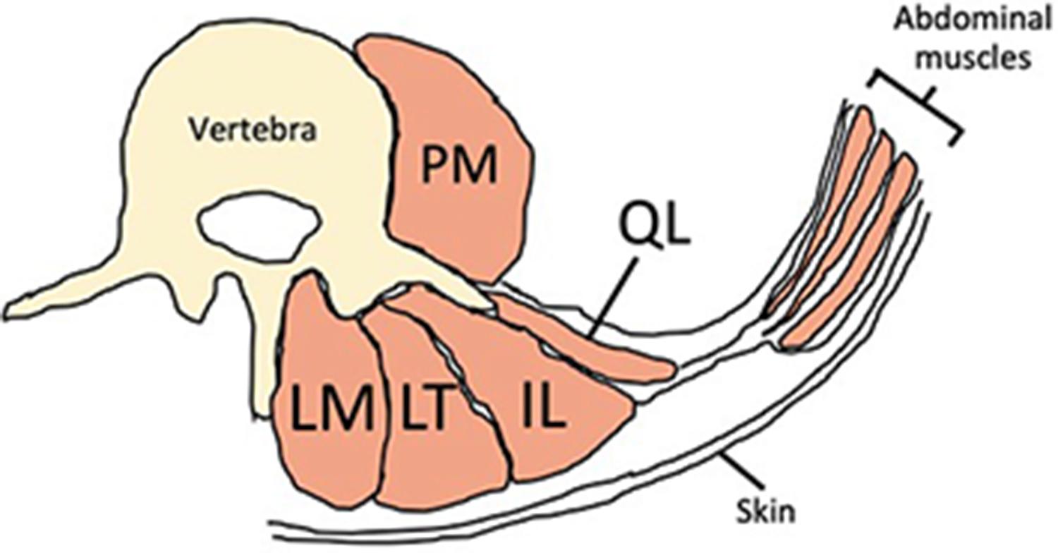 Figure 15.1, An axial view of back muscles. IL , iliocostalis lumborum; LM , lumbar multifidus; LT , longissimus thoracis; PM , psoas major; QL , quadratus lumborum.