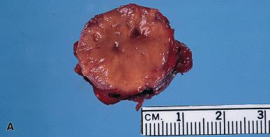 Figure 9.1, A and B, Gross appearance of two parathyroid adenomas. Note the roundish shape, the homogeneous appearance interrupted by a few foci of fresh hemorrhagic or cystic changes, and the brown to yellowish color.
