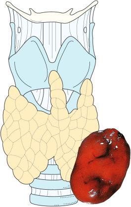 Figure 9.2, Parathyroid adenoma arising from the left lower parathyroid gland.