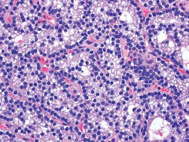 Figure 9.3, Parathyroid adenoma. The tumor is hypercellular, homogeneous, and well vascularized.