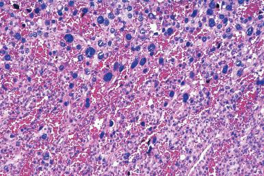 Figure 9.4, Parathyroid adenoma with clusters of bizarre nuclei. This feature is not an indication of malignancy.