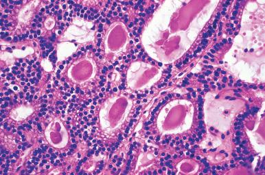 Figure 9.5, Parathyroid adenoma with follicular structures containing a colloid-like material simulating thyroid.