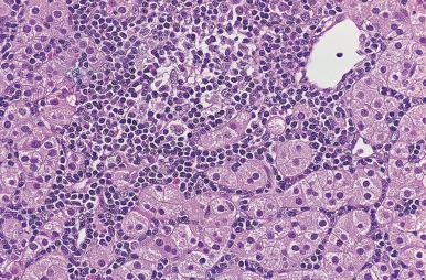 Figure 9.6, Heavy lymphocytic infiltrate within a parathyroid adenoma.