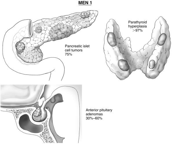 Fig. 62.1, The most common clinical features of multiple endocrine neoplasia type 1 (MEN 1).