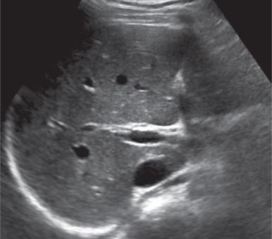 e-Figure 89.1, Normal liver ultrasound in an 11-year-old girl.