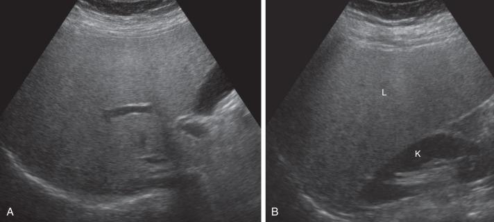 Figure 89.2, Fatty liver in an 11-year-old girl with NAFLD.