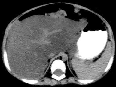 e-Figure 89.3, Fatty liver.