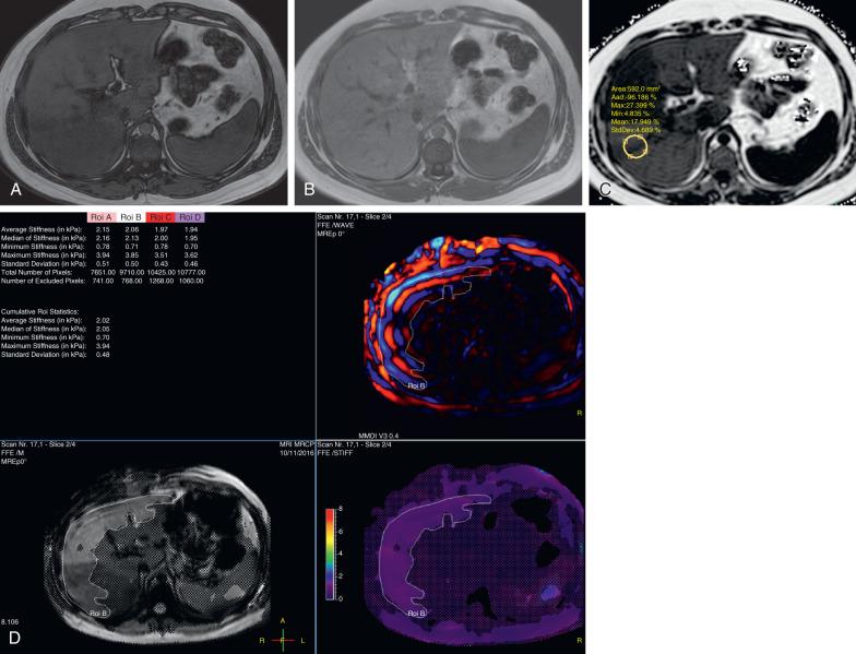 Figure 89.4, Fatty liver in an 18-year-old boy with elevated BMI and abnormal liver function tests.