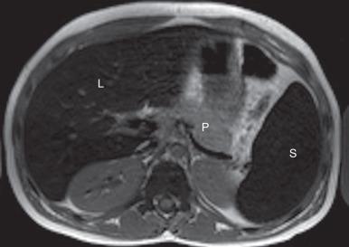 Figure 89.6, Transfusional iron overload.