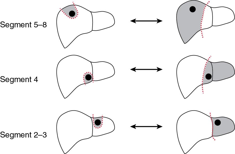 FIGURE 102A.1, Parenchymal-sparing and anatomic resection options for various hepatic lesions.