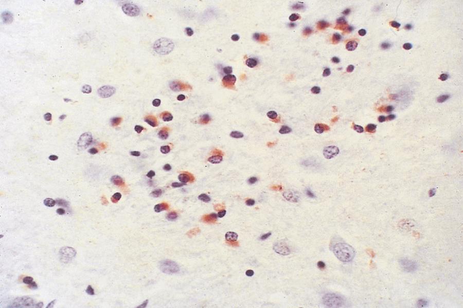 Fig. 96.11, Glial cytoplasmic inclusions in basal ganglia, immunostained with α-synuclein—typical of multiple system atrophy.