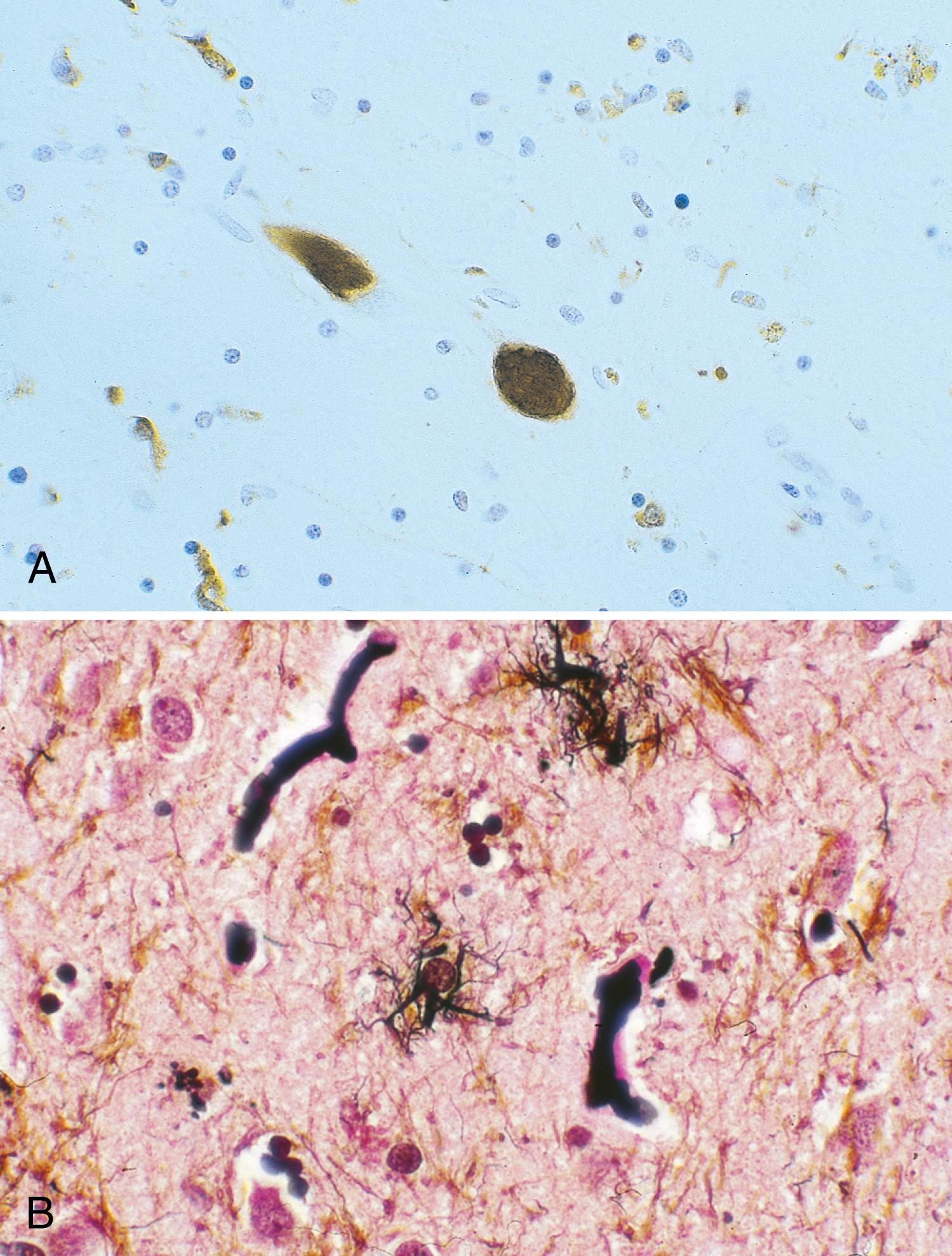 Fig. 96.13, Globose neurofibrillary tangle and tufted astrocytes in progressive supranuclear palsy (PSP). A, Tau-immunostained globose neurofibrillary tangles in neurons of globus pallidus. B, Gallyas silver-stained tufted astrocytes in globus pallidus of patient with PSP.
