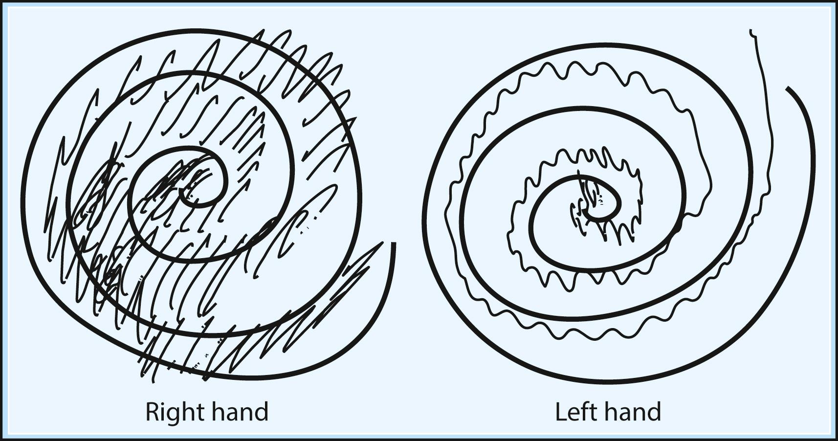 Fig. 96.14, Writing sample from a man with asymmetrical postural and action tremor of essential tremor.