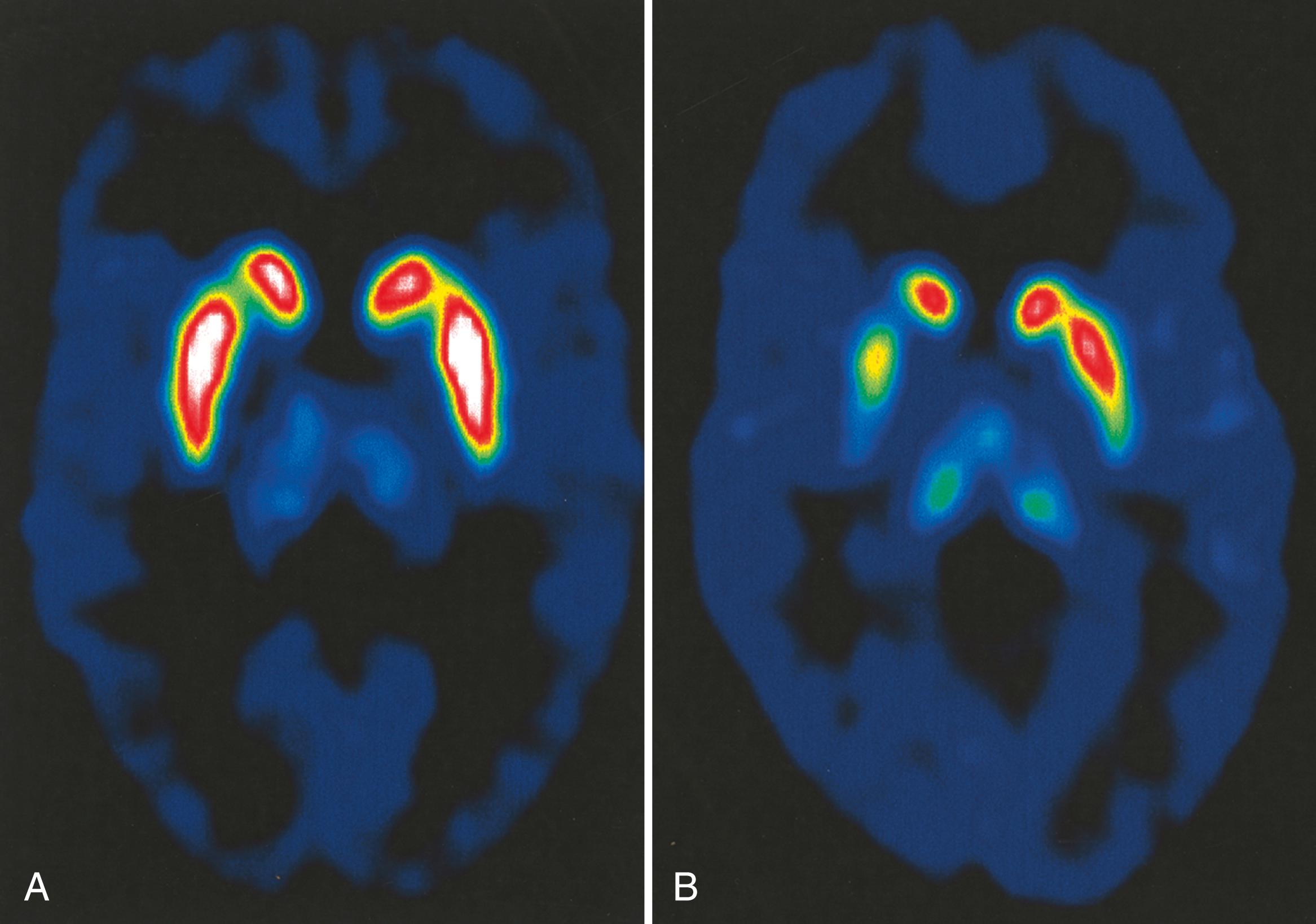 Fig. 96.5, Positron emission tomography scan with [ 11 C]RTI-32, which labels the presynaptic dopamine transporter in a normal control (A) and a subject with early Parkinson disease (PD) (B) . There is asymmetrically reduced uptake in PD, indicating asymmetrical loss of presynaptic dopaminergic neurons.