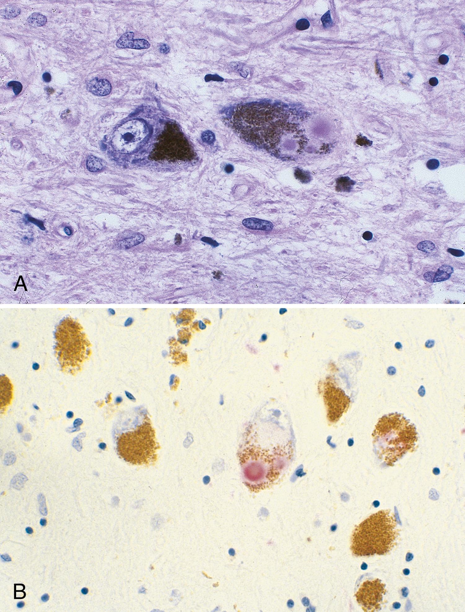 Fig. 96.6, Brainstem Lewy Bodies.