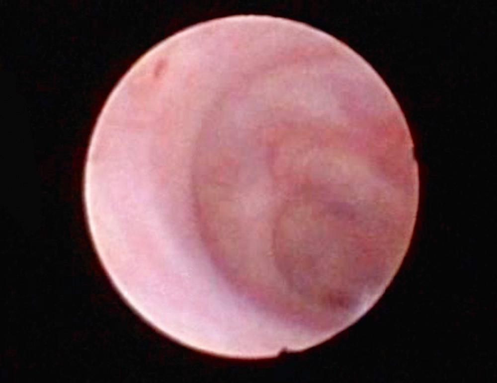 Fig. 27.2, Ductal dilatation immediately behind the stricture. The ductal wall appearance also differs from that of the stricture.