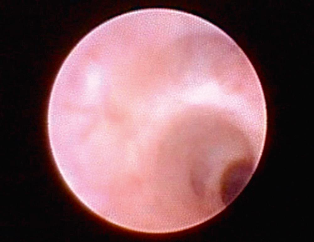 Fig. 27.3, Normal ductal wall appearance with visible mucosal vessels.