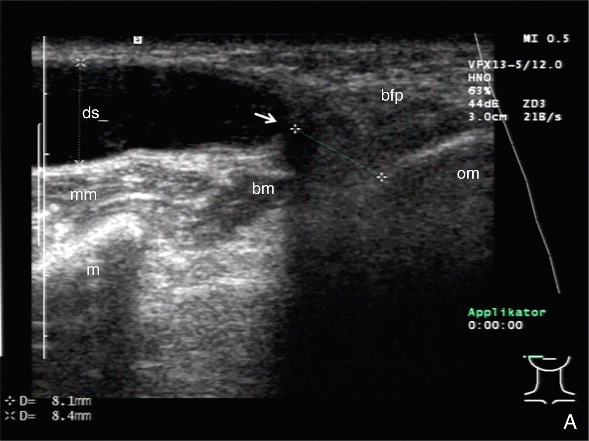 Fig. 28.1, (A) Ultrasound (US) in papillary distal stenosis with formation of a megaduct. Dilation of Stensen's duct (8.3 mm) with tendency to form a megaduct, no lumen visible distally (white arrow), which indicates the proximal end of the stenosis. The distance from this point to the oral mucosa was measured at 8.4 mm. (B) US in papillary stenosis associated with megaduct and ductal anomaly. Massive dilation of ds, in particular in the distal duct system (12.6 mm) with no lumen visible distally (white arrow), which indicates the proximal end of the possible stenosis. The echo-rich structure within the ductal lumen indicates a web or duct kinking (green arrow). The distance from this point to the oral mucosa was measured at 12.4 mm. Thickness of the bm was measured to be 3.4 mm. ds, Stensen's duct; mm, masseter muscle; m, mandible; om, oral mucosa; bm, buccinator muscle; bfp, buccal fat pad.