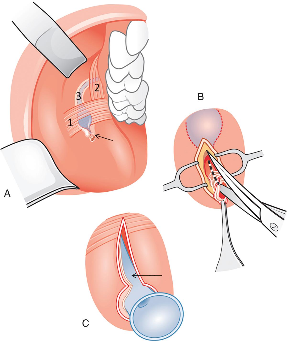 Fig. 28.2, Distal duct slitting/incision in papillary stenosis. (A) Short stenosis with residual lumen at or very near to the papilla (arrow). (B) Duct incision is performed through all layers of the scarred and stenotic part of the duct. Because no marsupialization can be performed, stent implantation is mandatory. (C) Situation after the stent (arrow) was positioned within the duct system. 1, buccinator muscle; 2, masseter muscle; 3, Stensen's duct.