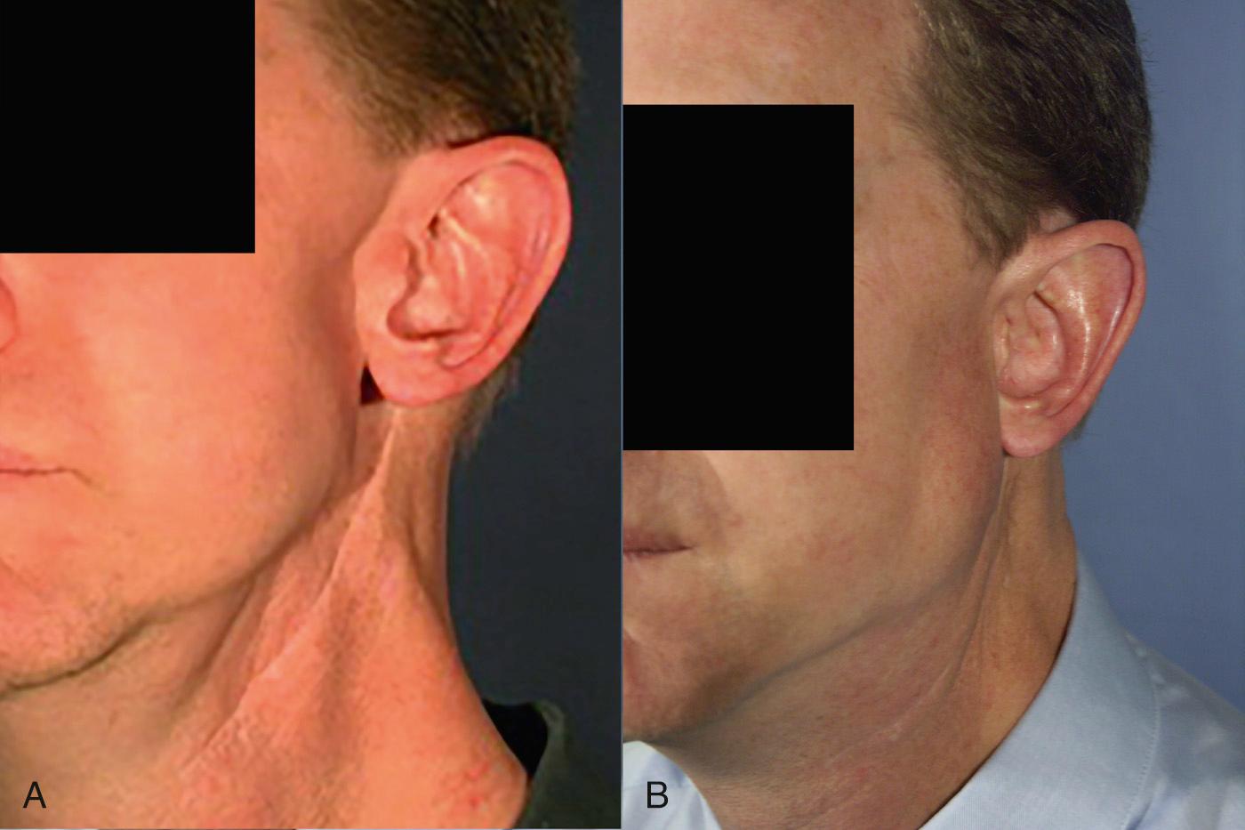 Fig. 40.1, (A) Deformity after radical parotidectomy and reconstruction by a SCM flap and facial nerve graft followed by radiotherapy. Atrophy of the SCM muscle leads to depression in the mandibular angle and in the cervical region. (B) Restoration of the facial contour after secondary reconstruction with an ALT flap.