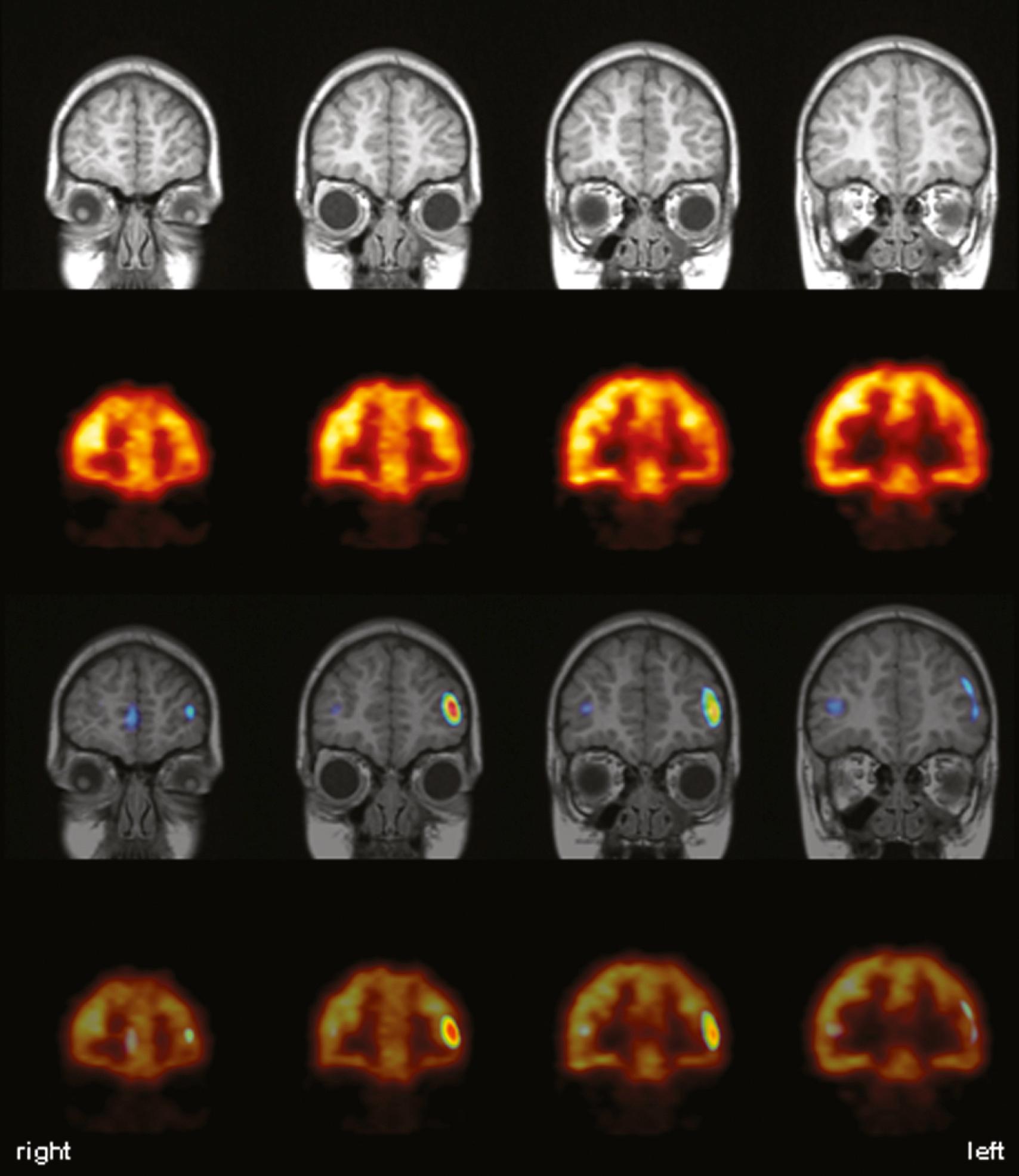 Fig. 39.4, Fluorodeoxyglucose F 18 ([ 18 F]FDG) PET and ictal [ 99m Tc] ethyl cysteinate dimer ([ 99m Tc]ECD) single photon emission computed tomography (SPECT) in left frontal lobe epilepsy. This patient’s MRI scan (top row) was normal, whereas [ 18 F]FDG PET showed extensive left frontal hypometabolism (second row) . Additional ictal and interictal [ 99m Tc]ECD SPECT scans were performed for accurate localization of seizure onset. Result of a SPECT subtraction analysis (ictal-interictal; blood flow increases above a threshold of 15%, maximum 40%) was overlaid onto the MRI and [ 18 F]FDG PET scan (third and fourth rows, respectively), clearly depicting the zone of seizure onset within the functional deficit zone given by [ 18 F]FDG PET.