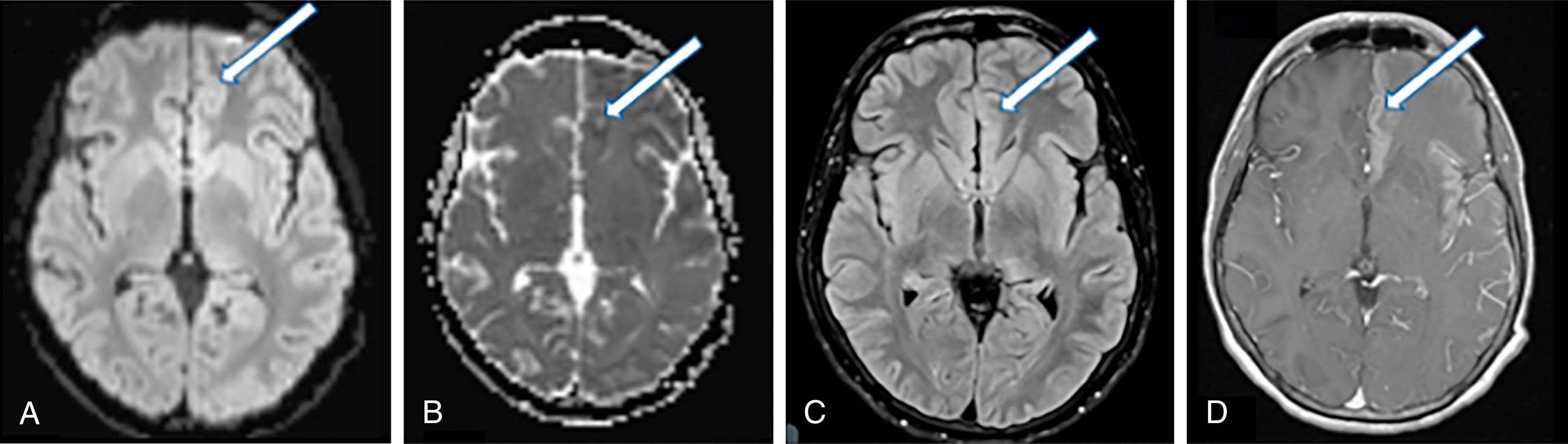 Fig. 39.5, Common MRI findings due to status epilepticus. Diffusion-weighted imaging (DWI) (A) sequence reveals increased intensity in the left insular and frontal cortices (white arrows) with corresponding decreased apparent diffusion coefficient (B). There are similar regions of increased intensity on fluid-attenuated inversion recovery imaging (C) and contrast enhancement (D) implying a component of vasogenic edema. These changes resolved on repeat MRI 1 week later.