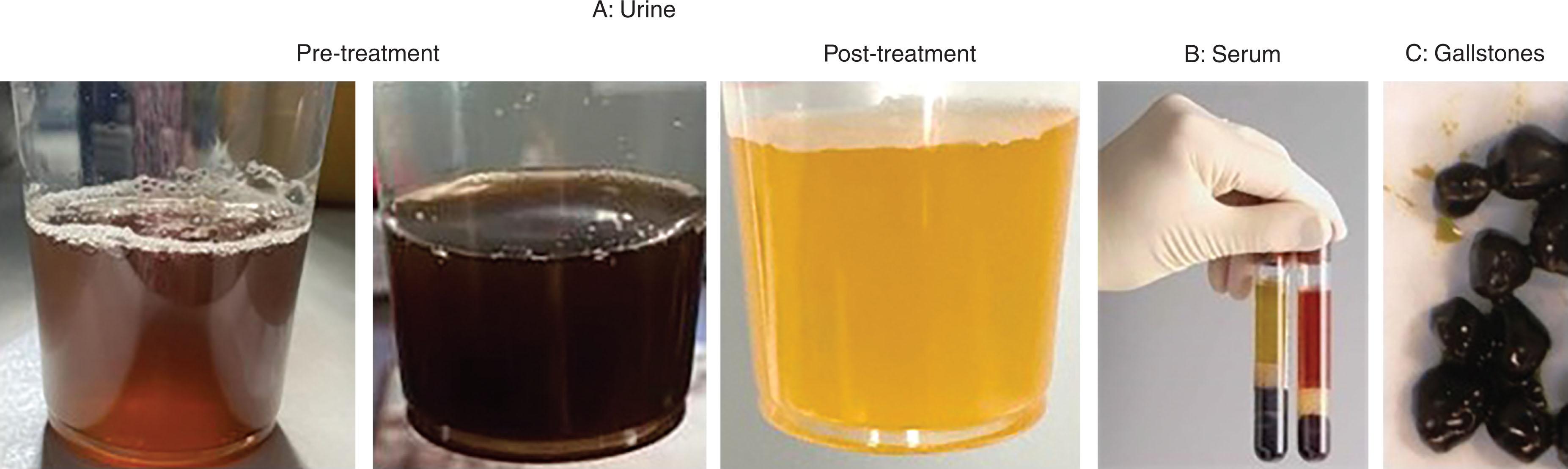 Figure 32.1, (A) Two urine samples from a patient with PNH with a large PNH clone, taken several days apart, prior to treatment. The urine color then normalized soon after starting ravulizumab. Note that since the darkening of the urine is “paroxysmal,” the normalization of the urine color is not sufficient to demonstrate an effect of any therapy– but rather the response is most rapidly demonstrated by the decrease in the lactate dehydrogenase (LDH). (B) Blood samples in a serum separator tube from a patient with PNH compared with the normal donor. Note the red color of the serum above the separator plug and the decreased size of the clotted red cells below the plug, consistent with anemia and intravascular hemolysis. (C) Symptomatic bilirubin gallstones from a cholecystectomy specimen in a patient with PNH on long-term treatment with a C5 inhibitor. Stone formation is a consequence of chronic extravascular hemolysis of various etiologies and is seen in some patients on eculizumab or ravulizumab. This complication was not seen historically in untreated patients with PNH in whom the hemolysis is largely intravascular. The reason for this is that in intravascular hemolysis, free hemoglobin is largely excreted in the urine and is not broken down to bilirubin, whereas for extravascular hemolysis, hemoglobin is broken down in the cells of the reticuloendothelial system, resulting in hyperbilirubinemia. Likewise, patients with PNH who are treated with C5 inhibition can develop iron overload, as seen in other forms of extravascular hemolysis, but this is not typically seen in intravascular hemolysis where iron is lost in the urine.