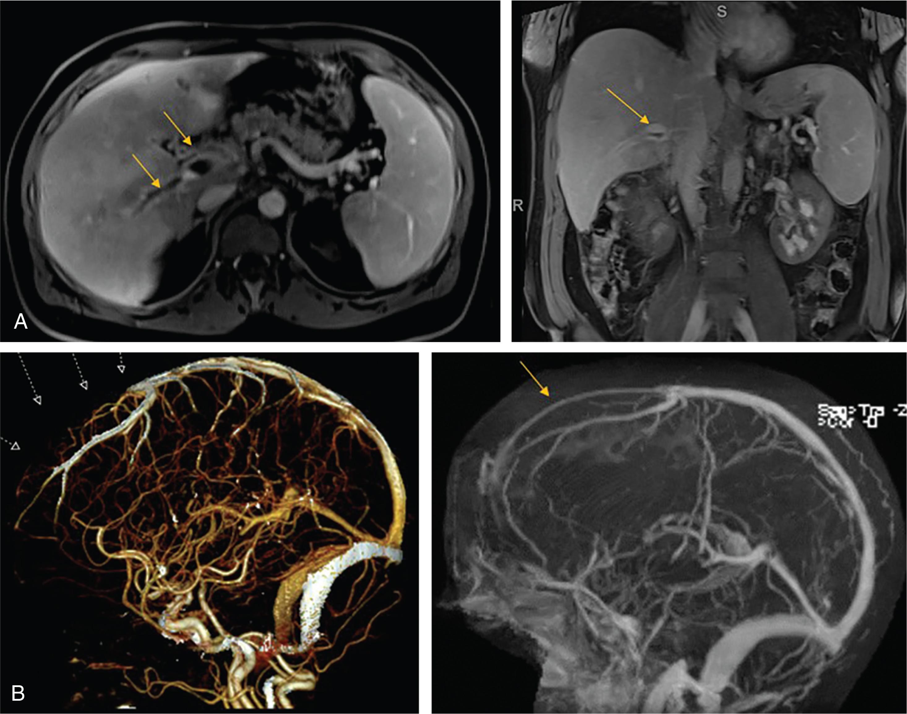 Figure 32.4, (A) Hepatic MRI images indicative of portal vein thrombosis in a patient with paroxysmal nocturnal hemoglobinuria. (B) Diminutive appearance of the anterior sagittal sinus seen on CT angiogram (left) and MR venogram (right) .