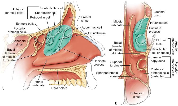 Fig. 7.1, Schematic drawings of the ethmoid sinuses showing sagittal (A) and axial (B) views of the structures involved in a partial ethmoidectomy (shaded area).