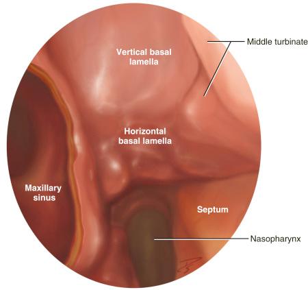 Fig. 7.3, Artist’s depiction of a 0-degree endoscopic view of the right basal lamellae. The ethmoid bulla has been removed; the vertical and horizontal segments of the basal lamellae are shown. The posterior ethmoids are entered at the junction between the vertical and horizontal segments.