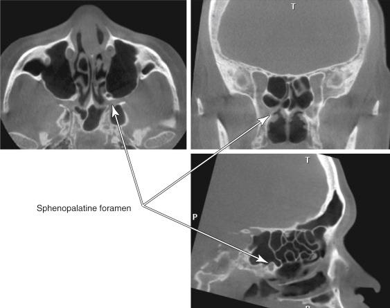 Fig. 7.4, Computed tomographic scans of the sphenopalatine foramen in three planes. Note the location anterior to the sphenoid, posterior and superior to the middle turbinate.