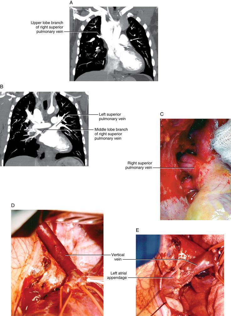 Figure 7-1, A Contrast-enhanced CT scan of partial anomalous pulmonary venous connection—right superior pulmonary vein to superior vena cava. The right upper lobe branch of the right superior pulmonary vein is connected to the superior vena cava. B Contrast-enhanced CT scan of partial anomalous pulmonary venous connection—right superior pulmonary vein to superior vena cava. The right middle lobe branch of the superior pulmonary vein is hypoplastic and connects normally to the left atrium. Hypoplasia of the right middle lobe vein is appreciated when compared with the normal-sized, unobstructed left superior pulmonary vein. This rare variant of partial anomalous pulmonary venous connection results in pulmonary venous obstruction from the right middle lobe. Collateral venous drainage is by way of the mediastinum, causing esophageal and tracheal varices associated with bleeding. C Operative photograph of partial anomalous pulmonary venous connection—right superior pulmonary vein to superior vena cava. The right superior pulmonary vein is connected to the superior vena cava above the cavoatrial junction. The superior vena cava is enlarged due to the extra volume of blood flow entering the cava from the right superior pulmonary vein. D Partial anomalous pulmonary venous connection—left pulmonary vein to innominate vein—viewed through a left thoracotomy. Branches of the left pulmonary vein are connected to a vein coursing vertically outside the pericardial sac. This vertical vein is the remnant of the left superior vena cava. It drains to the innominate (left brachiocephalic) vein. Pulmonary vein branches are controlled with vessel loops. E Operative repair of partial anomalous pulmonary venous connection—left pulmonary vein to innominate vein. The vertical vein (left pulmonary vein) is rotated inferiorly and medially for anastomosis to the left atrial appendage, using a flap of the appendage to create a large anastomosis.