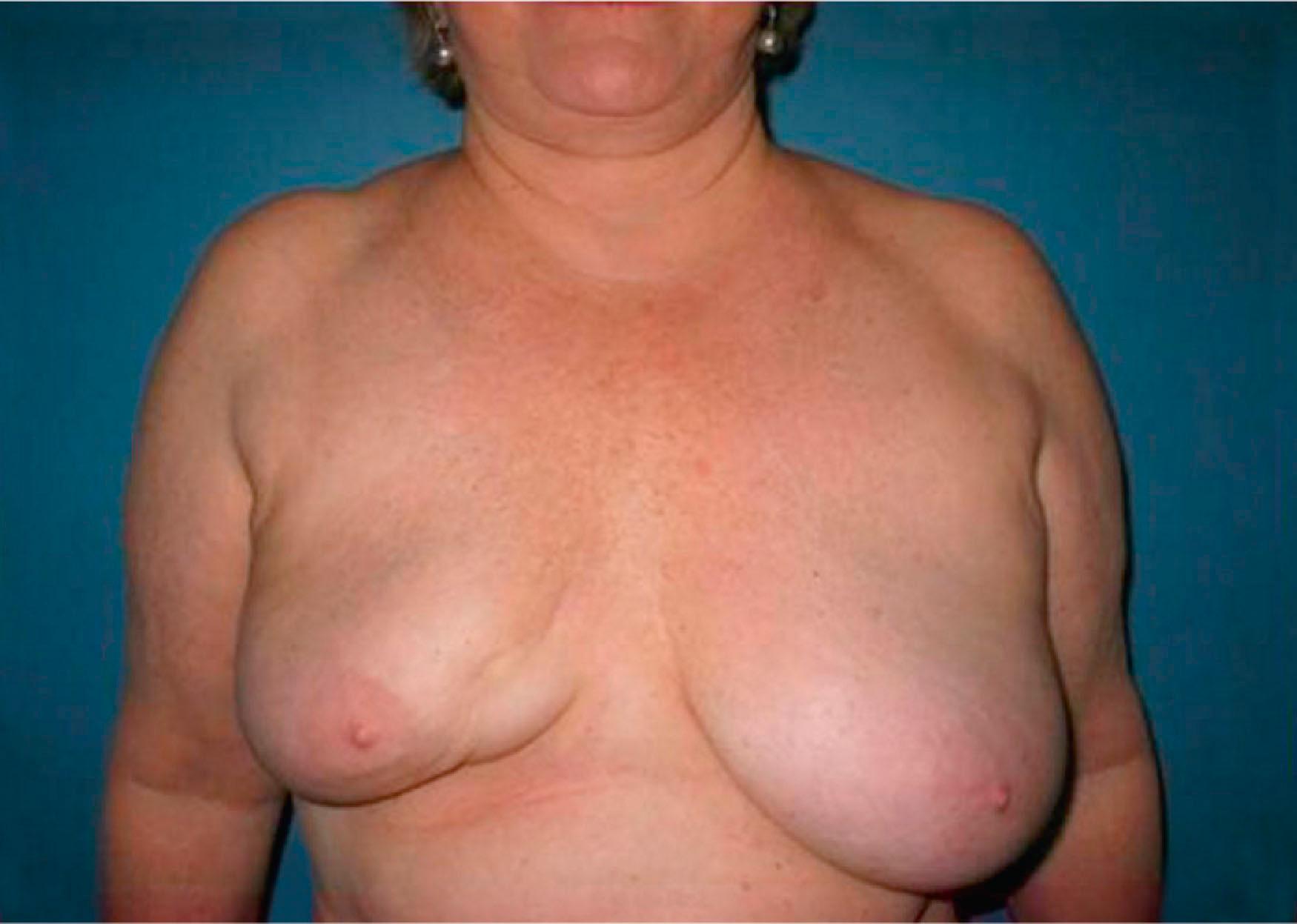 Figure 45.1, A 42-year-old woman who underwent a 20-g resection from the lower inner quadrant. Her resultant breast-conserving therapy deformity demonstrates shape and size distortion 2 years following radiation therapy.