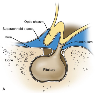 Figure 19.1, (A) Normal appearance of the sella turcica. (B) Early changes of primary empty sella with herniation of the arachnoid membrane and cerebrospinal fluid (CSF) through a defect in the diaphragm sella. (C) Progressive herniation of arachnoid membrane and CSF through the defect with effacement of the pituitary gland and inferior displacement of the optic chiasm.