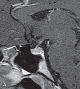 Figure 19.2, (A–E) Primary empty sella syndrome: Multiple sagittal T1-weighted postcontrast images demonstrating slow, gradual progressive effacement and downward displacement of the pituitary gland with mild expansion of the sella turcica. Note the initial slight expansion of the anterosuperior sella and subtle gradual effacement of the anterosuperior aspect of the pituitary gland 2 (B) and 4 (C) years after initial imaging. Effacement of the gland is more prominent 6 years later (D) and expansion with marked effacement is clearly evident 11 years later (E).