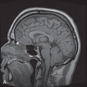 Figure 19.3, (A and B) Stable primary empty sella. Sagittal T1-weighted images demonstrating a partially empty sella. Note that there has been no progressive displacement of the pituitary gland or bony expansion of the sella turcica over a period of 9 years (B).