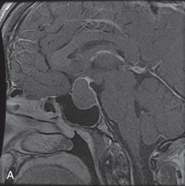 Figure 19.5, Secondary empty sella. (A–E) Sagittal postcontrast imaging at time 0, 3 months, 7 months, 1 year, and 2 years after medical treatment for a pituitary macroadenoma demonstrating progressive volume loss of the pituitary gland and replacement with cerebrospinal fluid, reflecting secondary empty sella.