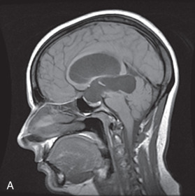 Figure 19.6, Secondary empty sella. Sagittal T1 (A) and sagittal three-dimensional constructive interference in steady state (B) sequence demonstrating severe enlargement of the third and lateral ventricles with normal appearance of the fourth ventricle in a patient with aqueductal stenosis. Marked dilation of the anterior third ventricle led to secondary chronic severe expansion of the sella with effacement of the pituitary gland.