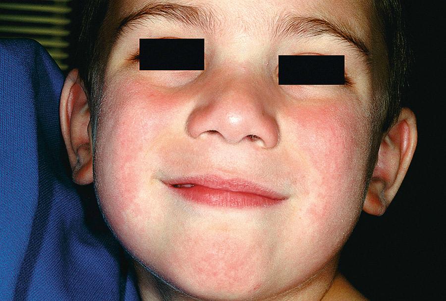 Fig. 278.1, Erythema infectiosum.