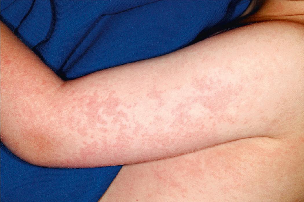 Fig. 278.2, Erythema infectiosum.